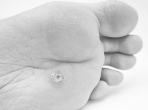 Viral Verrucae Removal Royal Leamington Spa