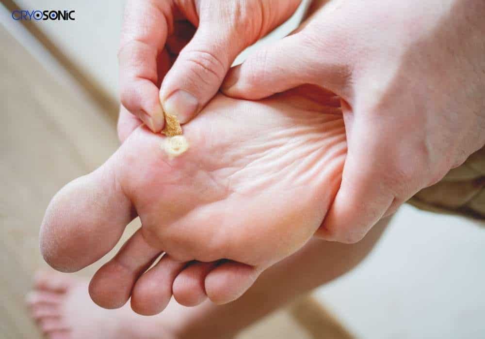 Exactly how do warts fall off Royal Leamington Spa