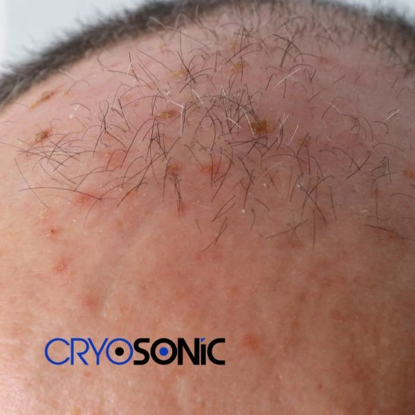 Access Seborrhoeic Keratosis removal from the comfort of your own home! Call us today in Royal Leamington Spa