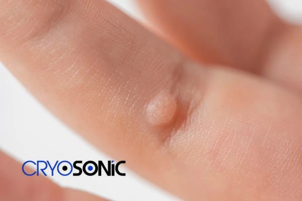 Contact Cryosonic today to learn more about us Royal Leamington Spa now! Royal Leamington Spa