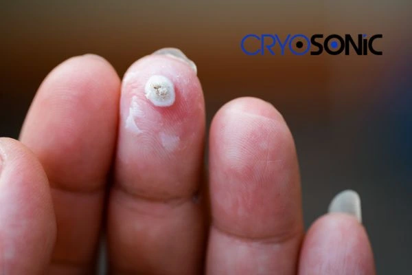 Learn more about us Royal Leamington Spa at Cryosonic. Book in today! Royal Leamington Spa