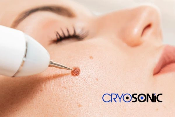 why choose us at Cryosonic for blemish removal? Find out more now Royal Leamington Spa