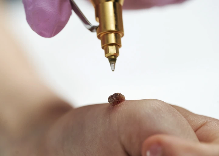 Cryopen For Children Bristol Royal Leamington Spa