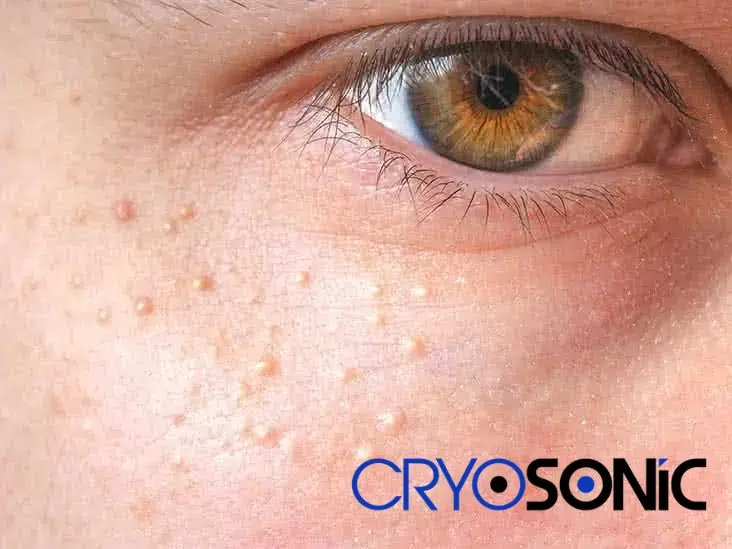 Cryosonic&rsquo;s CryoPen Approach to Milia Removal Royal Leamington Spa Royal Leamington Spa