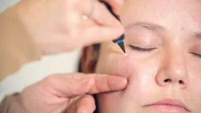 Aftercare Advice Following Milia Removal in Royal Leamington Spa