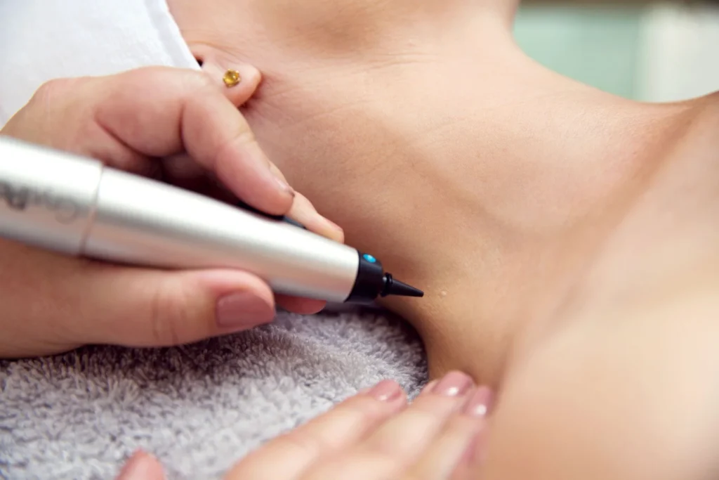 CryoPen Royal Leamington Spa precisely treating Molluscum Contagiosum lesions, showing safe and effective removal for faster healing by Cryosonic Royal Leamington Spa