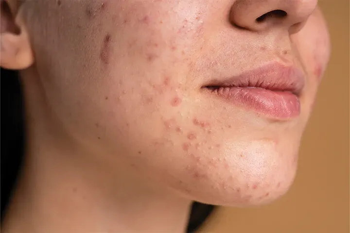 CryoPen precisely removing Skin Tags (fibroepithelial polyps), showing safe and effective treatment for smoother, clearer skin Royal Leamington Spa