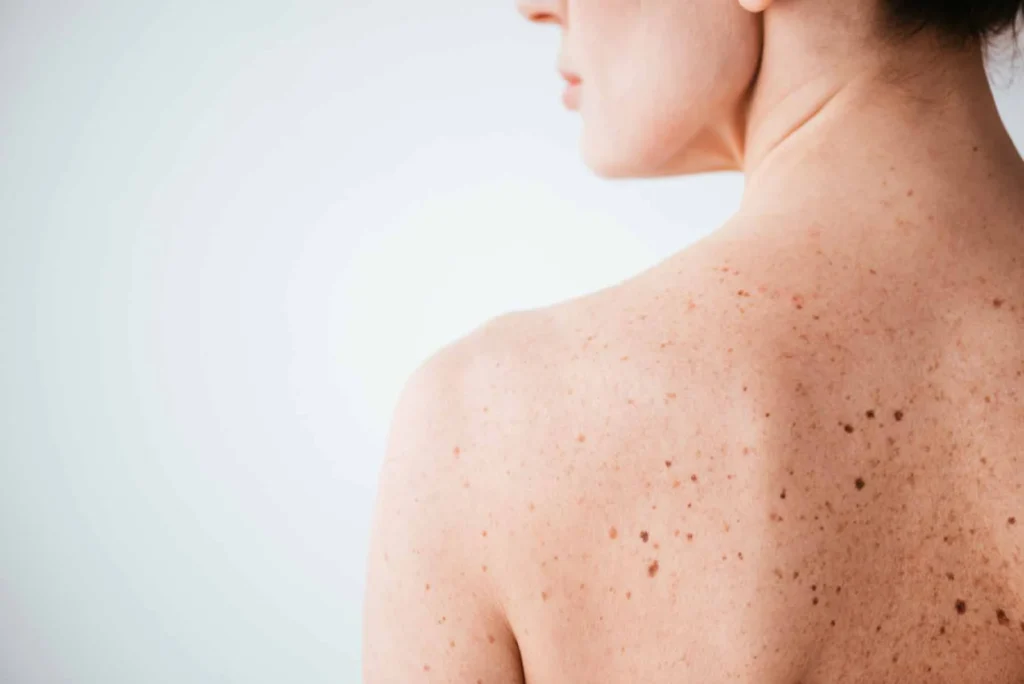 Sun Damage : Understanding UV Effects and Skin Repair Options Royal Leamington Spa