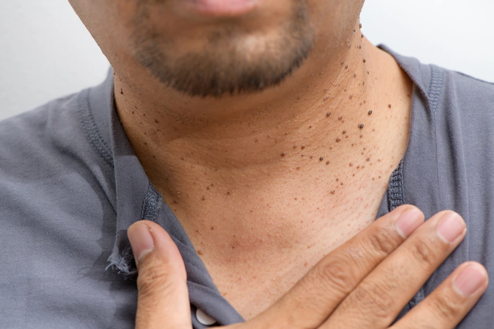 image of dermatofibroma removal Royal Leamington Spa Royal Leamington Spa