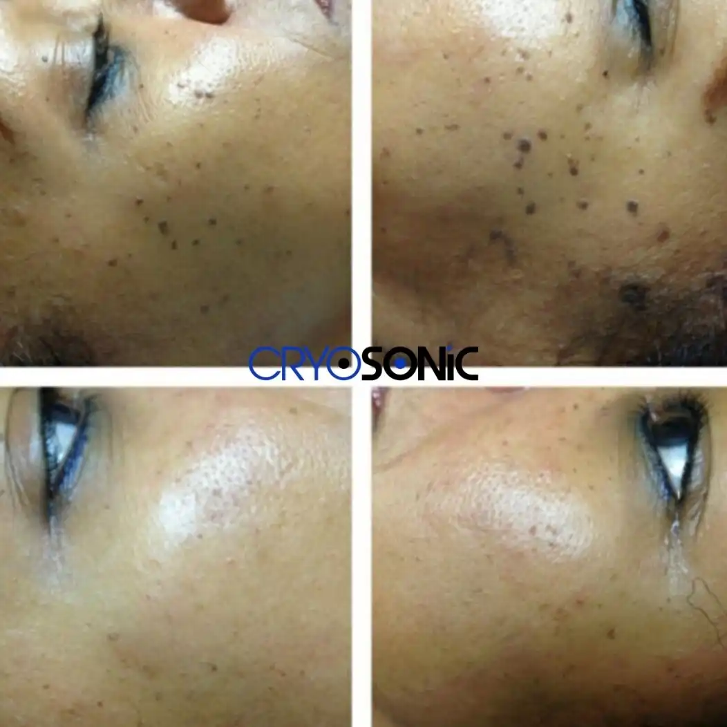 Why Skin Shows Pigmentation After Treatment Royal Leamington Spa