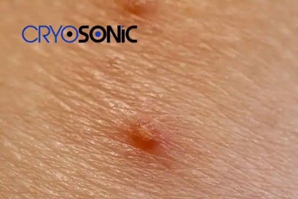 Molluscum Contagiosum Treatment Royal Leamington Spa Royal Leamington Spa