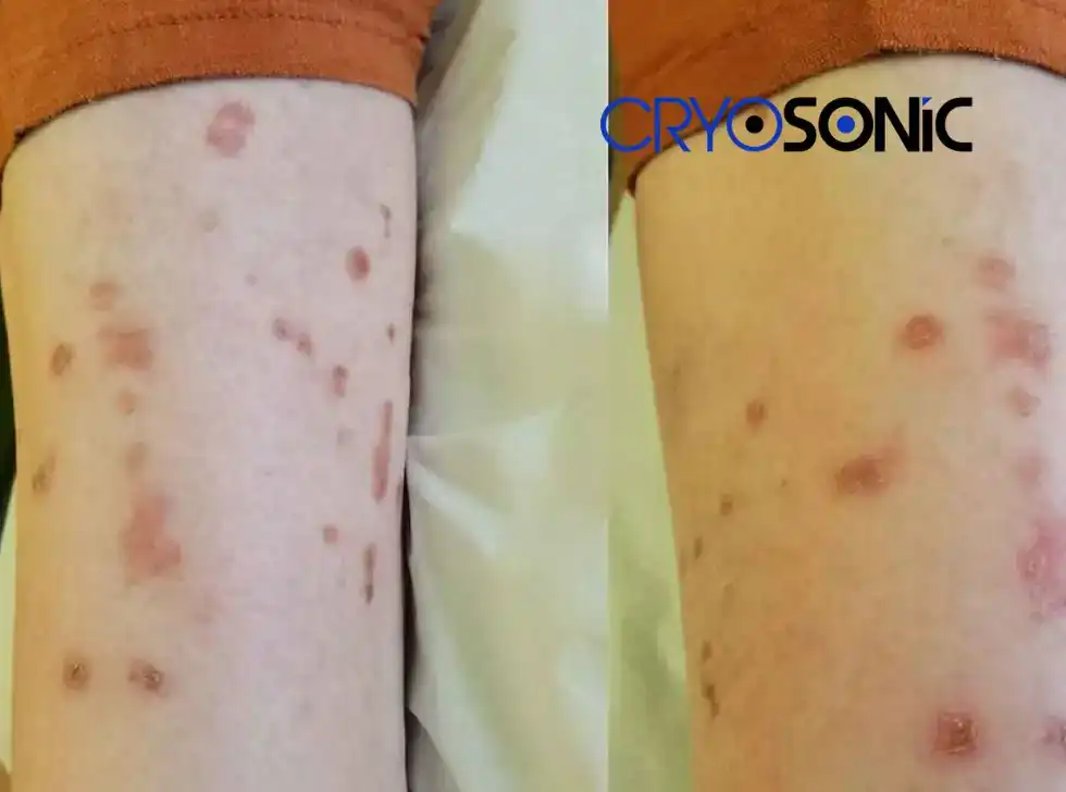 Recovery and Aftercare for Porokeratosis Treatment Royal Leamington Spa Royal Leamington Spa