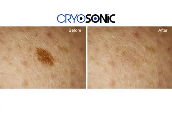 Before and after age spot removal Royal Leamington Spa Royal Leamington Spa