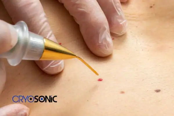 Image of cherry angioma removal Royal Leamington Spa Royal Leamington Spa