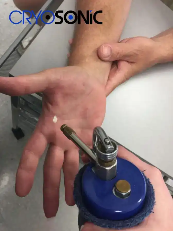 Temperature Differences: OTC vs Medical-Grade Cryotherapy Royal Leamington Spa